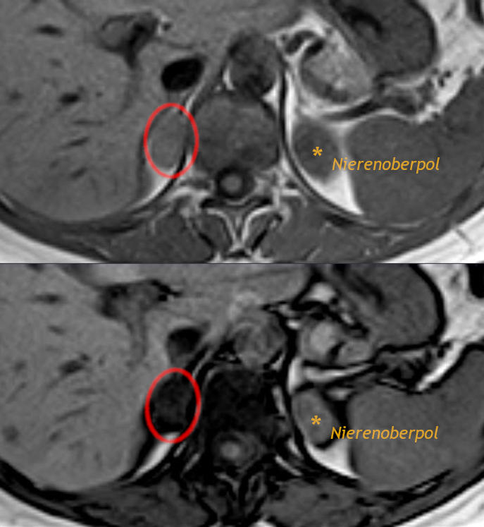 Paired in-phase and opposed-phase adrenal MRI images showing reduced lesion signal on opposed-phase imaging.