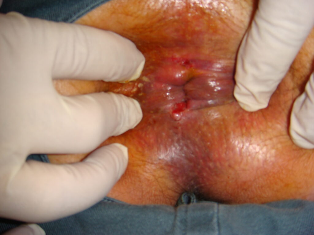 Clinical photograph showing a chronic posterior anal fissure with associated secondary changes.