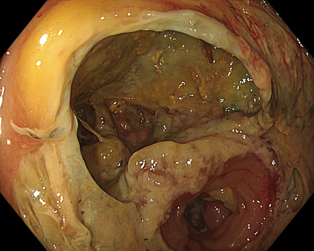 Endoscopic image showing a visible defect at a gastrointestinal anastomotic line.