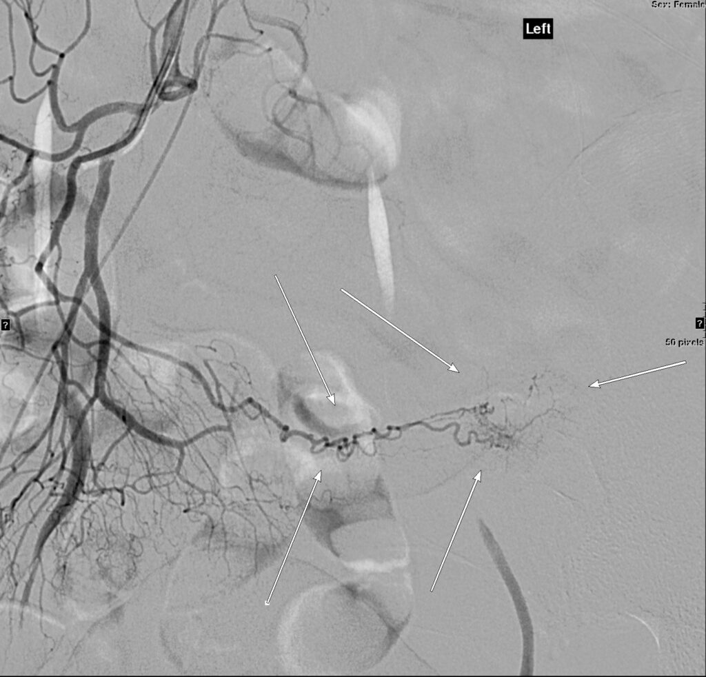 Selective mesenteric angiogram demonstrating an anomalous vessel supplying a distal small-bowel diverticulum.