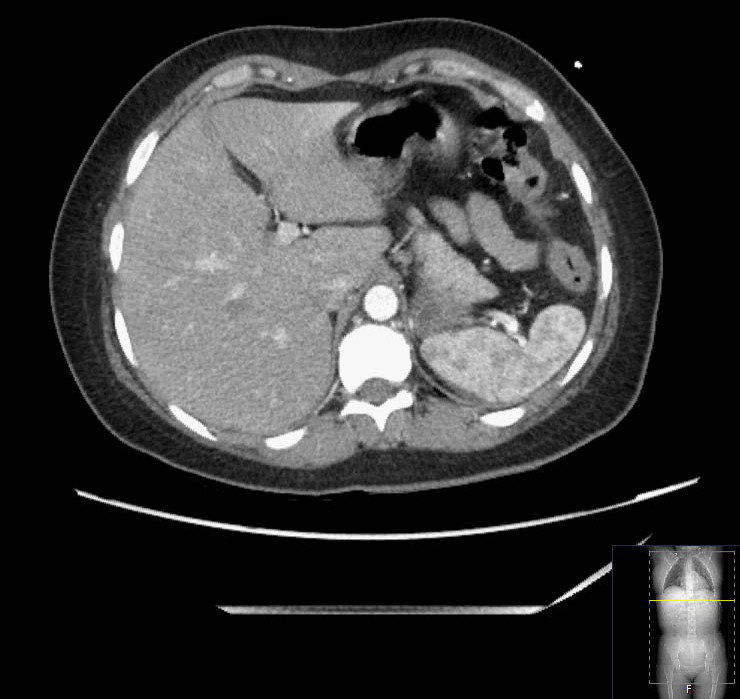 Axial CT showing an inflamed appendix with surrounding inflammatory change and a localized collection.