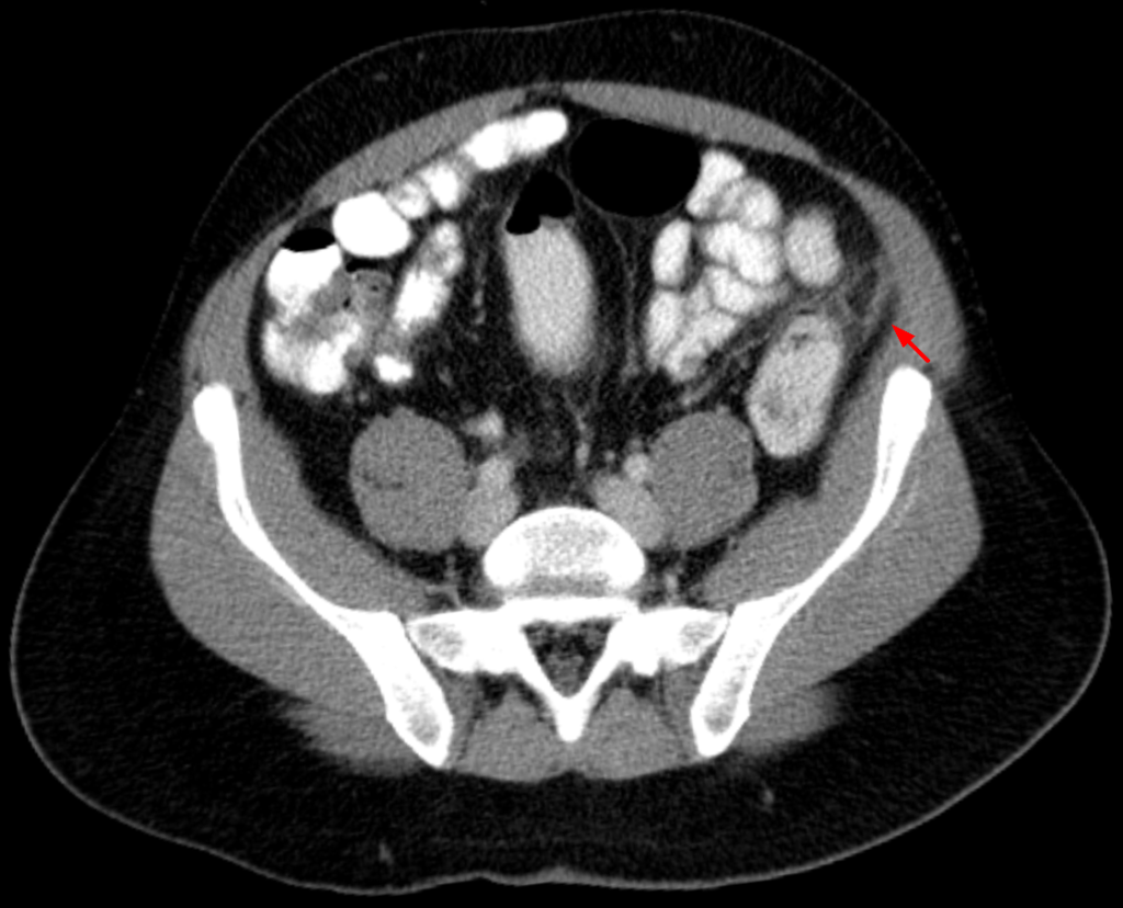 Axial contrast CT showing a small inflamed fat-density lesion immediately adjacent to the colon.