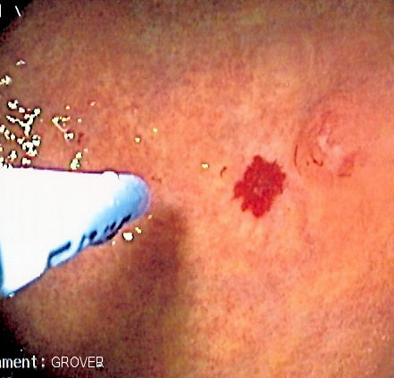 Colonoscopic image showing endoscopic argon plasma treatment of a flat vascular mucosal lesion.