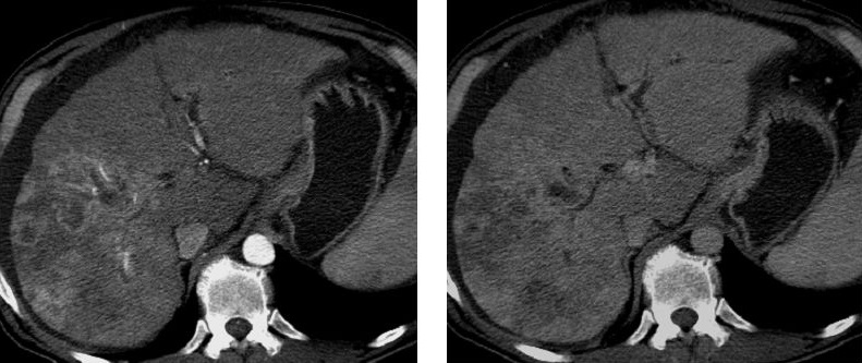 Paired arterial and portal-venous CT images showing a focal hepatic lesion within a cirrhotic liver.