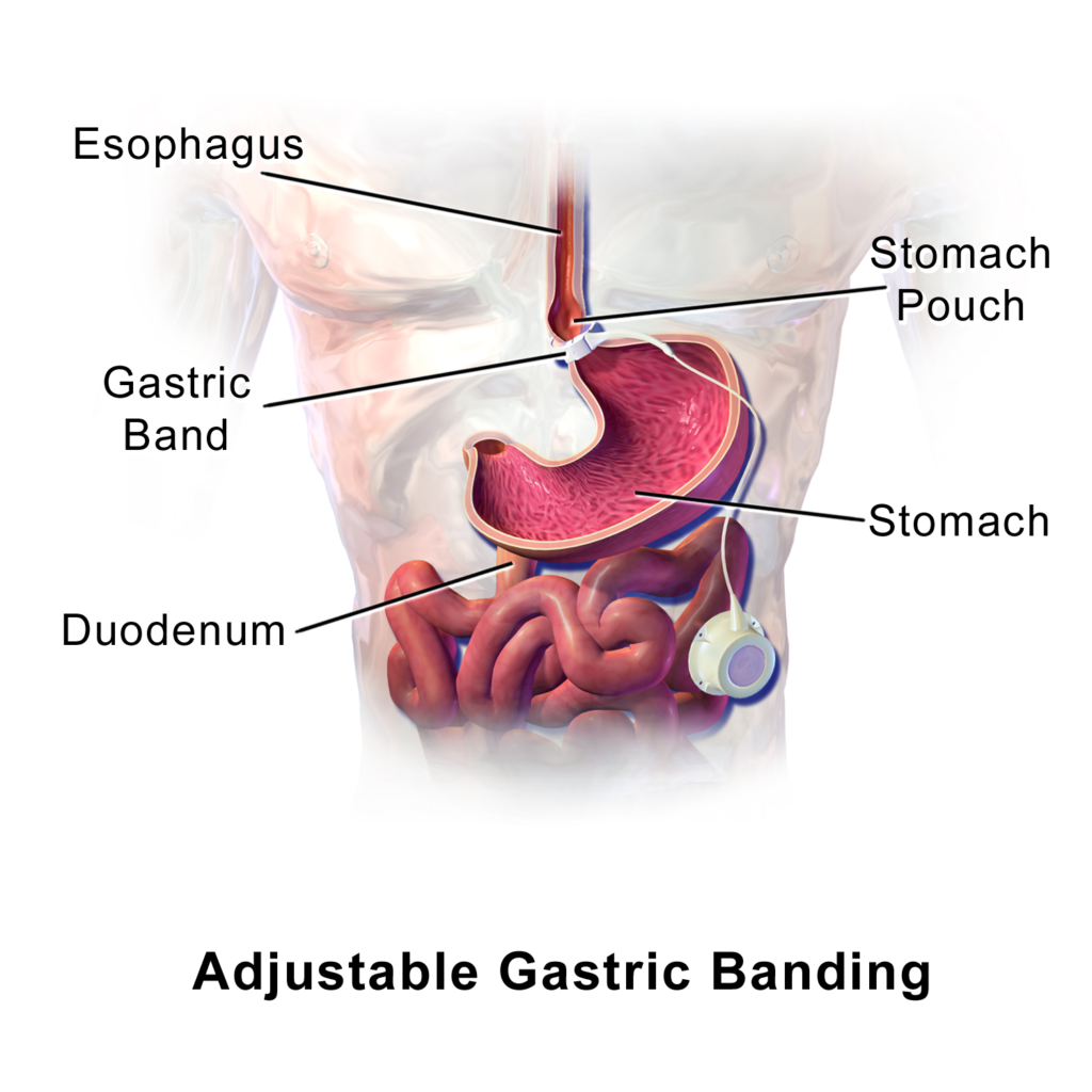 Anatomical illustration showing an adjustable band encircling the proximal stomach and connected to a subcutaneous access port.