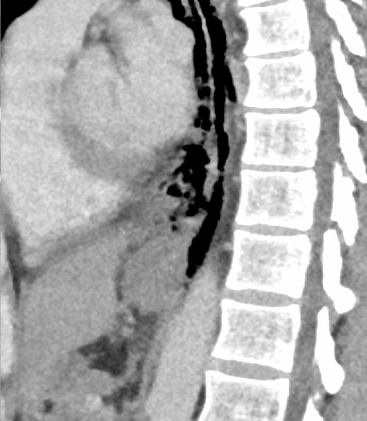 Sagittal CT showing distal esophageal-wall discontinuity with adjacent mediastinal gas.