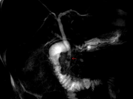MR cholangiopancreatographic image showing filling defects within the distal common bile duct.