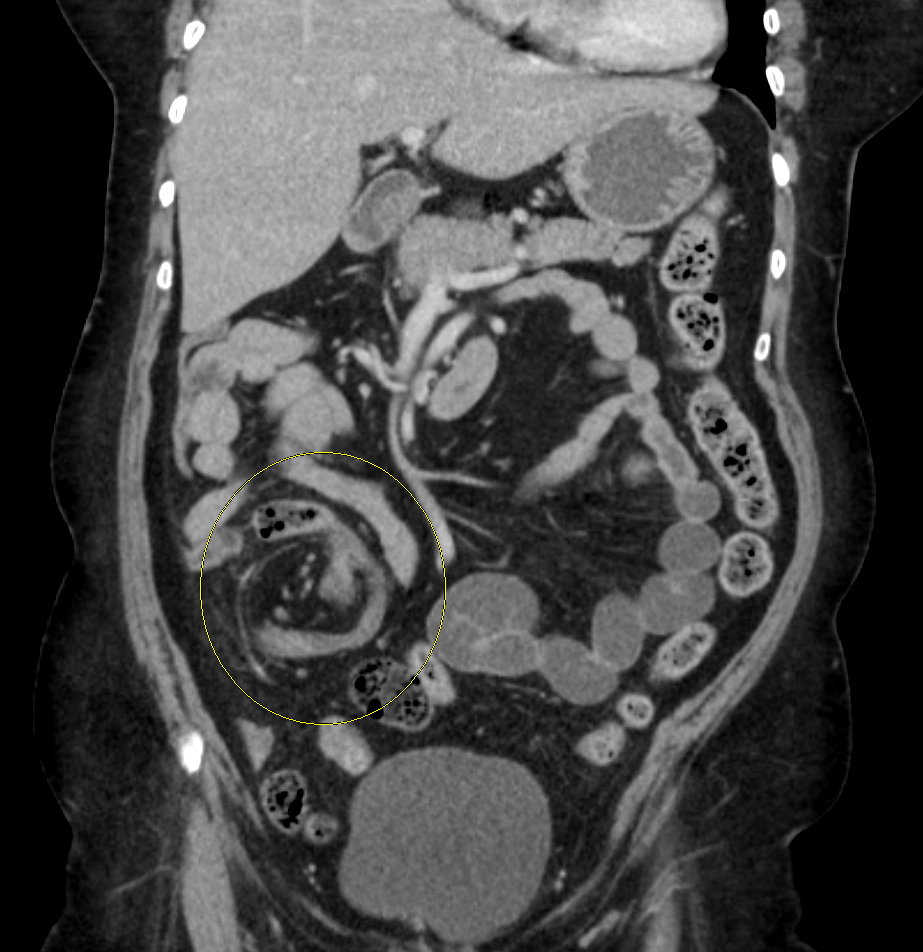 Abdominal CT showing a markedly displaced dilated cecum with twisting of its mesentery.