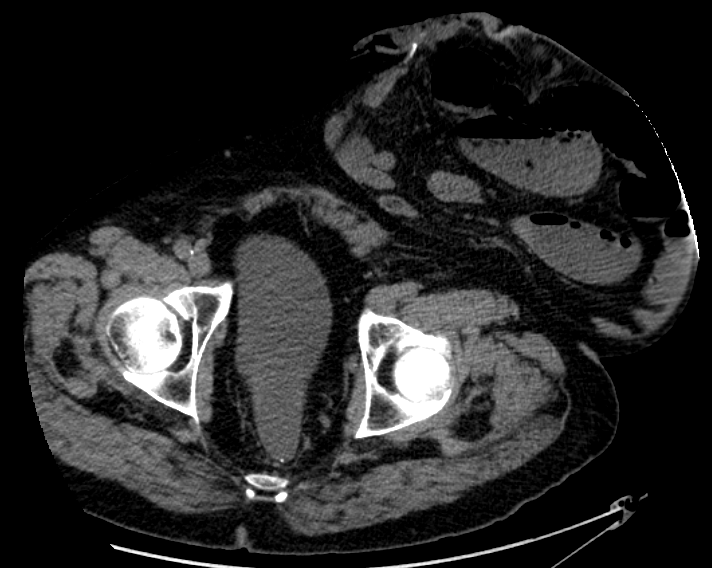 Axial CT showing a colostomy with a large adjacent sac containing bowel loops.