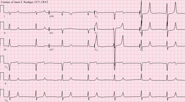 Twelve-lead ECG showing peaked T waves together with prolonged repolarization from combined hyperkalemia and hypocalcemia.