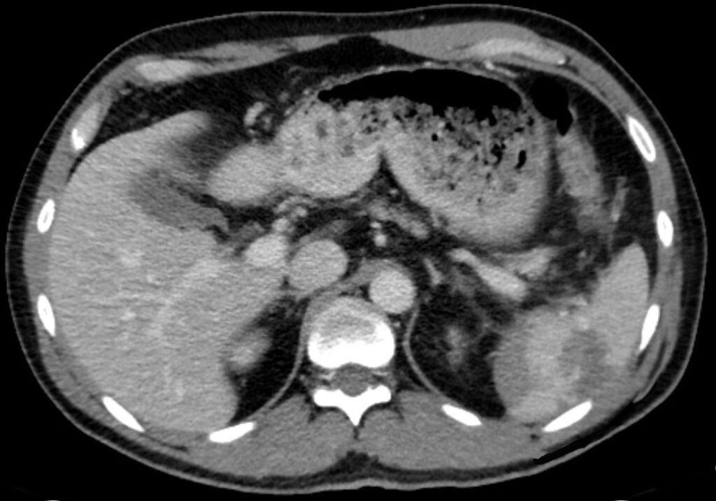 Contrast-enhanced axial CT showing traumatic splenic disruption with surrounding blood and focal vascular contrast leakage.