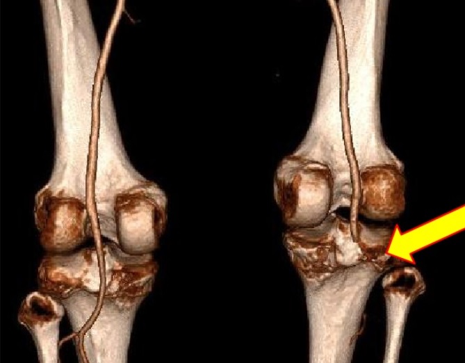 Three-dimensional CT angiographic reconstruction showing abrupt interruption of the right popliteal arterial flow.