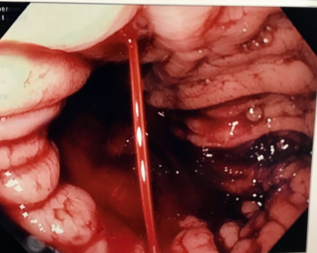 Endoscopic image showing focal active arterial bleeding through otherwise minimally abnormal gastric mucosa.