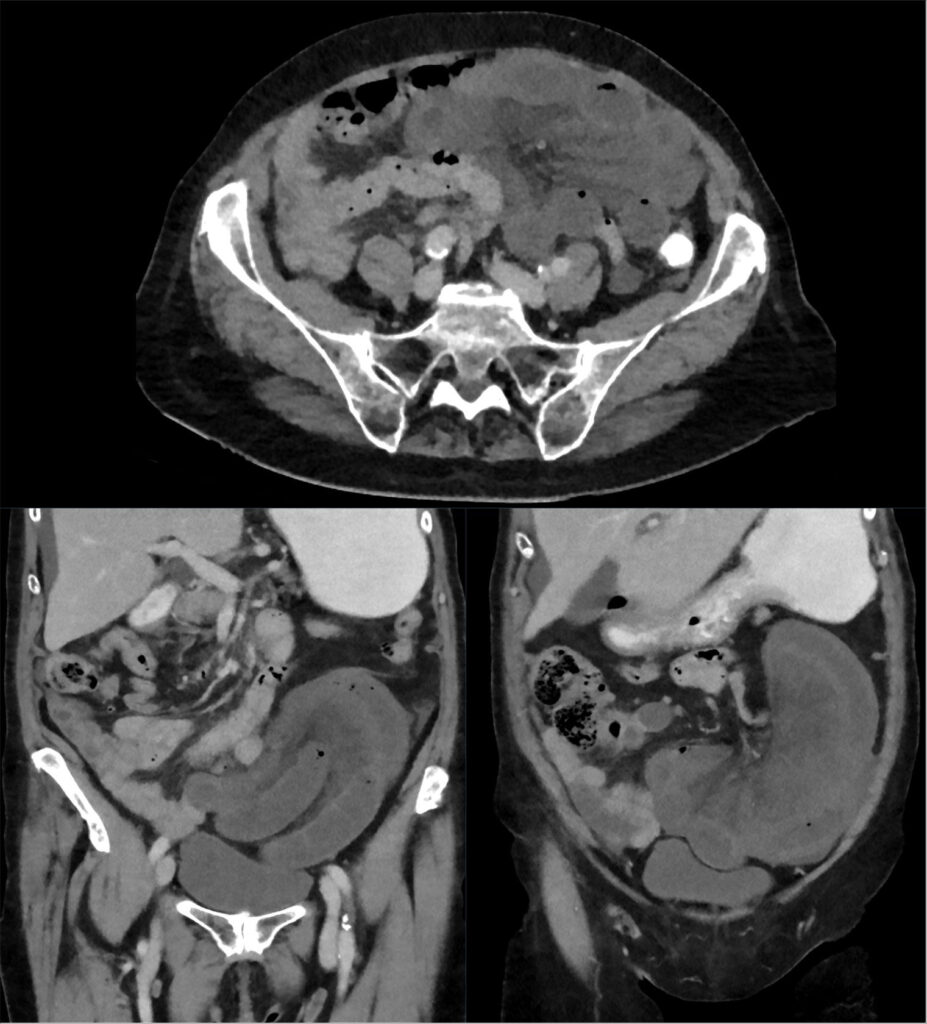 Axial and coronal contrast CT images showing clustered small bowel and twisted congested mesenteric vessels caused by internal herniation.