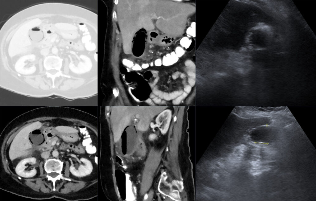 Combined CT and ultrasound images showing gas within and around an inflamed gallbladder.