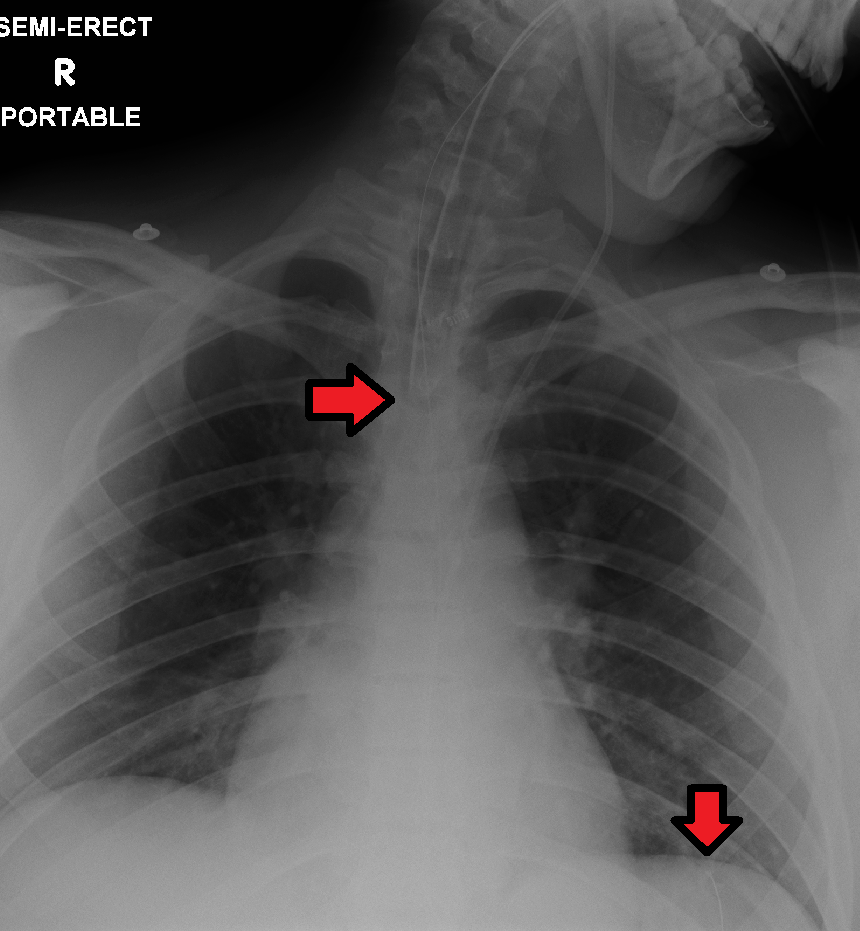 Portable radiograph displaying enteric tubing coursing below the diaphragm into the gastrointestinal tract.