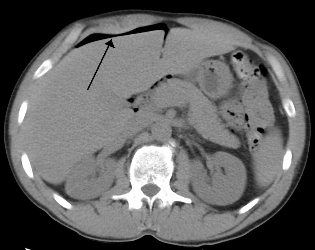 Abdominal CT showing free gas collecting outside the gastrointestinal tract within the peritoneal cavity.