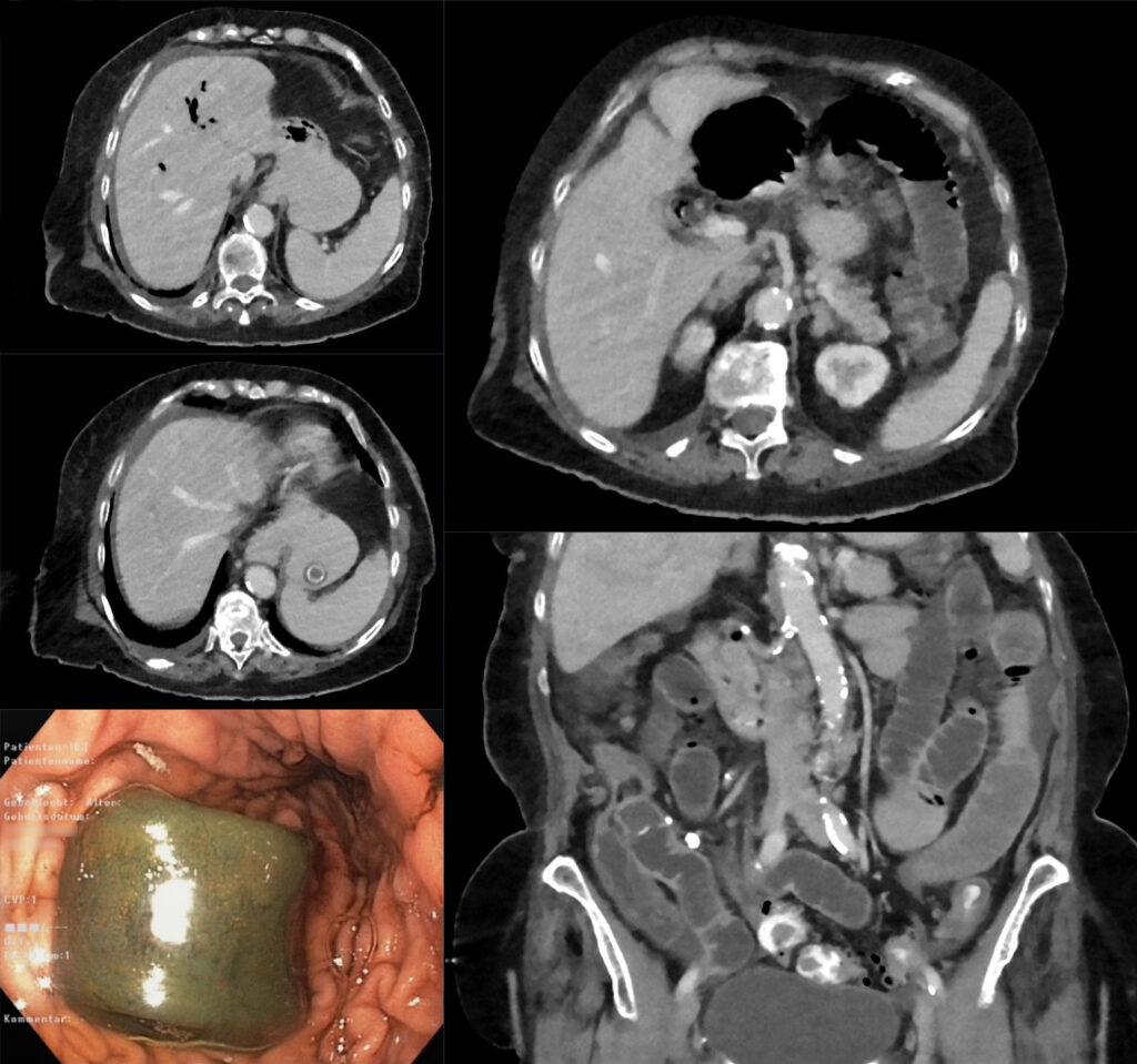 Contrast-enhanced CT montage showing small-bowel dilatation, pneumobilia, and an ectopic gallstone near the terminal ileum.