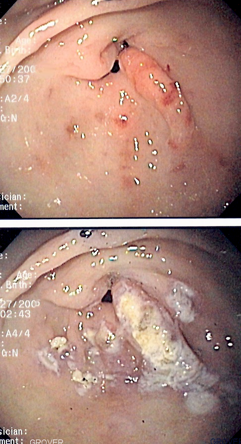 Endoscopic images showing longitudinal erythematous vascular stripes in the gastric antrum before and after treatment.