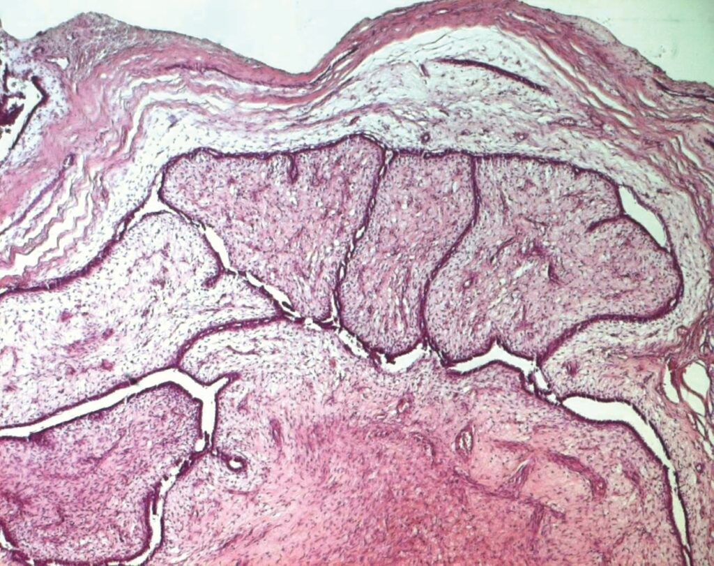 Breast histology showing a biphasic fibroepithelial lesion with projecting stromal fronds.
