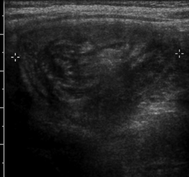 Transverse abdominal ultrasound showing concentric alternating echogenic and hypoechoic bowel rings.