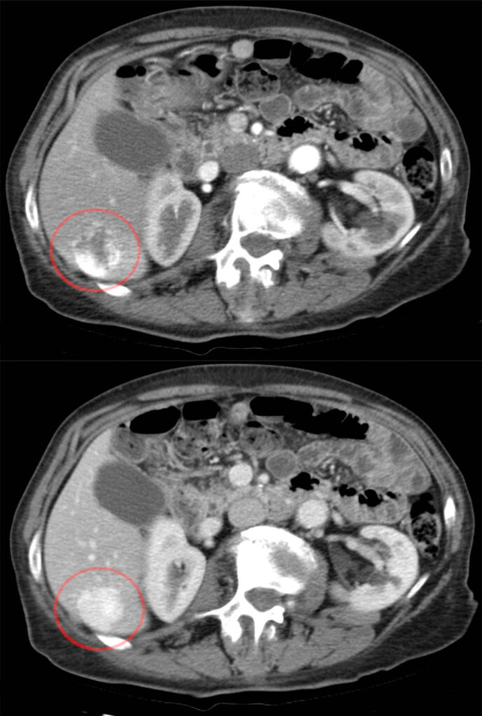 Paired arterial and portal-venous CT images showing peripheral nodular enhancement followed by central contrast fill-in.