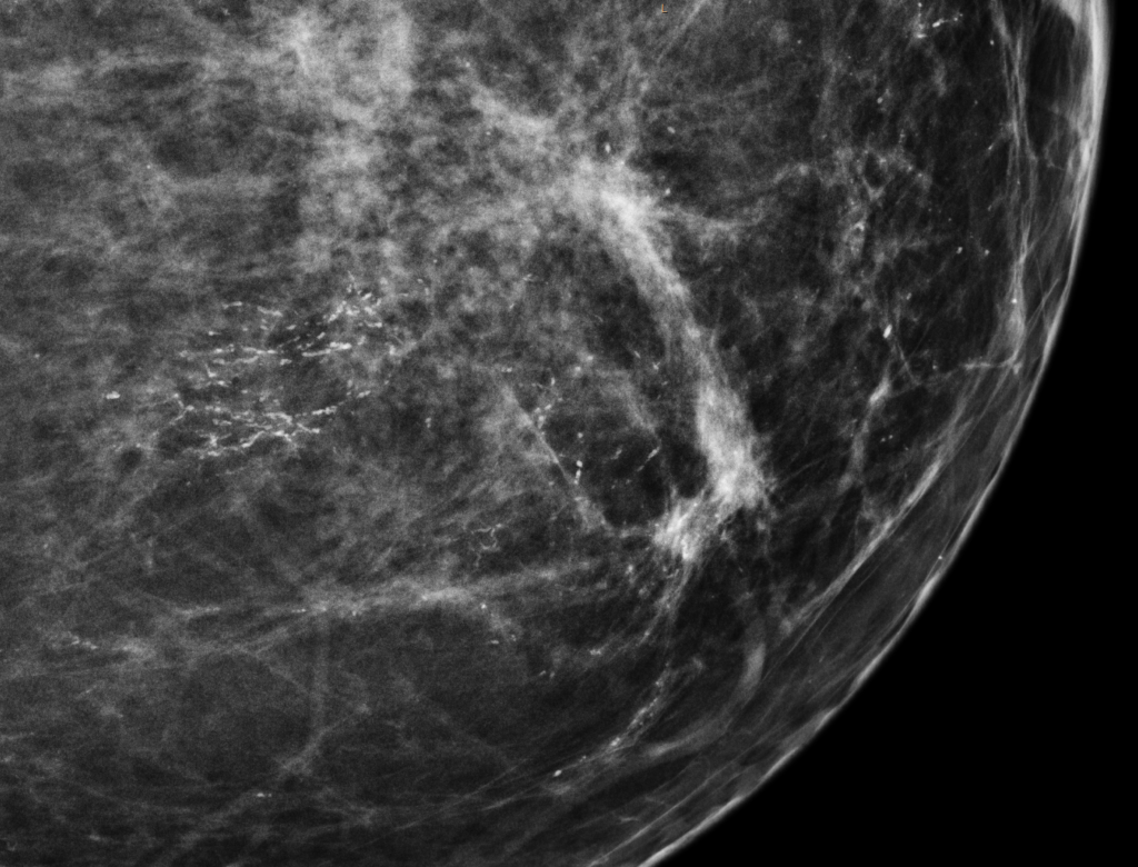 Magnified craniocaudal mammographic view showing clustered suspicious microcalcifications.