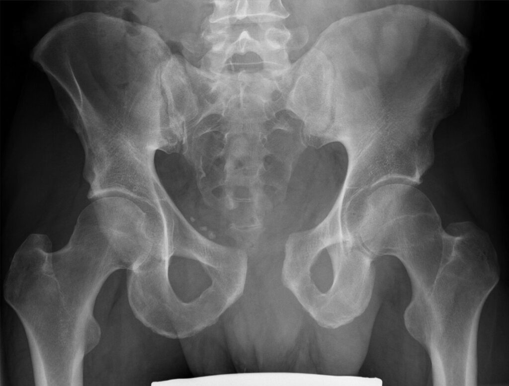 Anteroposterior pelvic radiograph showing marked pubic-symphysis separation and widening of the pelvic ring.