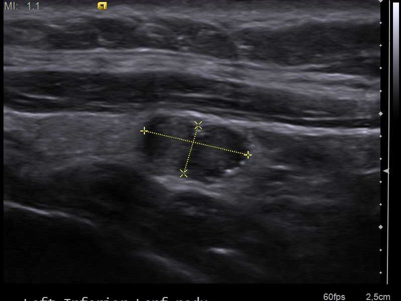 Cervical ultrasound showing an abnormal lymph node containing echogenic calcific foci.