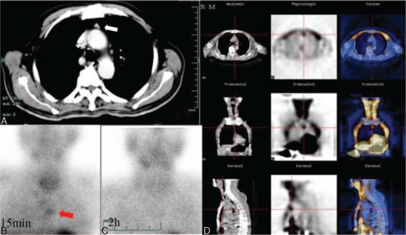 Multimodality SPECT-CT study localizing an ectopic hyperfunctioning parathyroid lesion in the superior mediastinum.