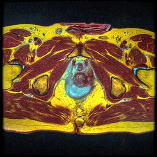 Pelvic MRI showing a U-shaped fluid collection extending around the anal canal.
