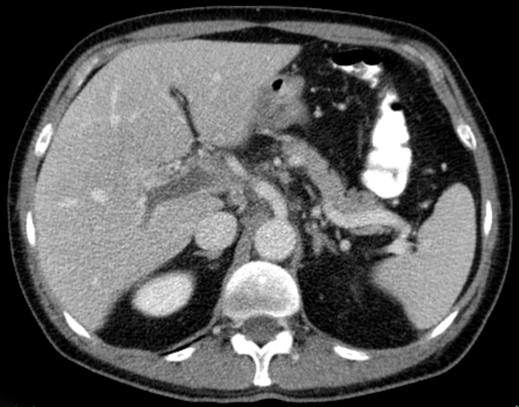 Contrast-enhanced abdominal CT showing a filling defect within the portal venous system.