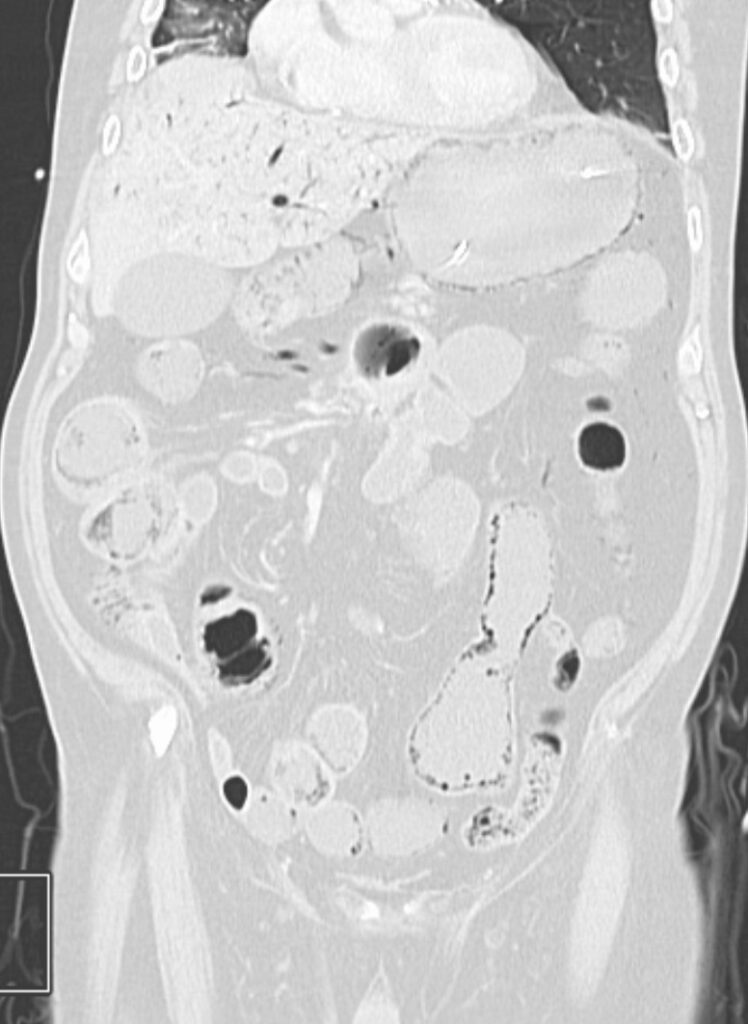 Coronal CT showing gas within bowel walls and branching gas within the portal venous system.