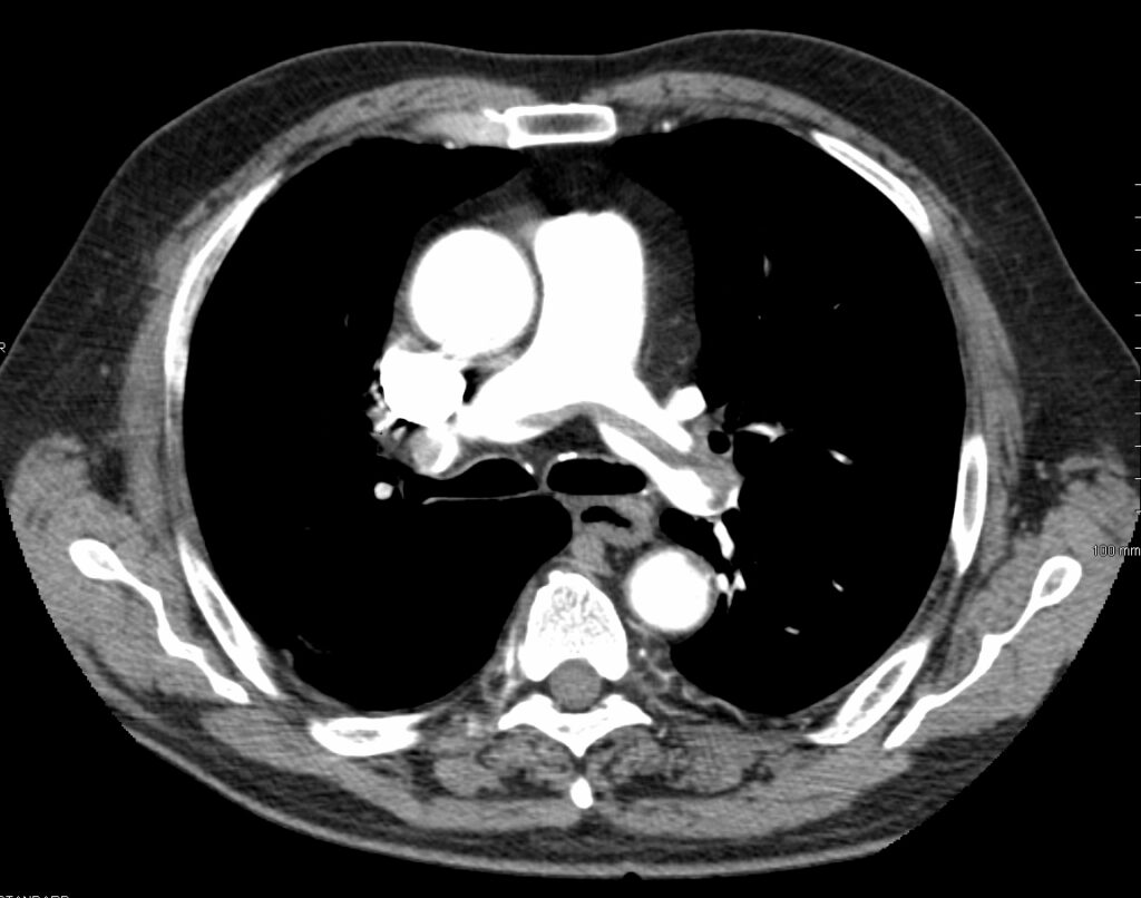 CT pulmonary angiogram showing a large filling defect straddling the pulmonary-artery bifurcation.