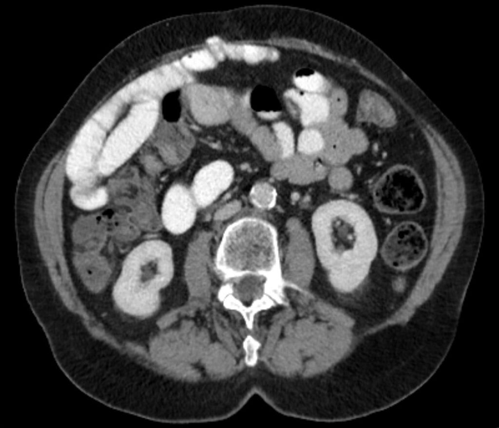 Contrast-enhanced CT showing only the antimesenteric portion of small bowel entering an abdominal-wall defect.