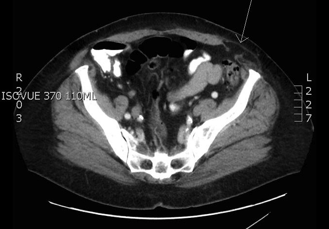 Axial abdominal CT showing bowel protruding through a lateral abdominal-wall defect.