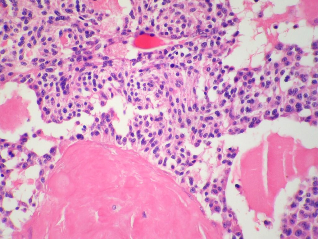 Thyroid histology showing nests of tumor cells separated by extracellular amyloid material.