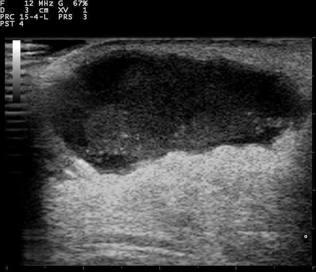 Breast ultrasound showing a complex fluid-containing lesion with internal echoes.