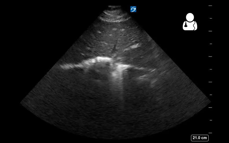 Subcostal cardiac ultrasound showing a large pericardial fluid collection surrounding the heart.