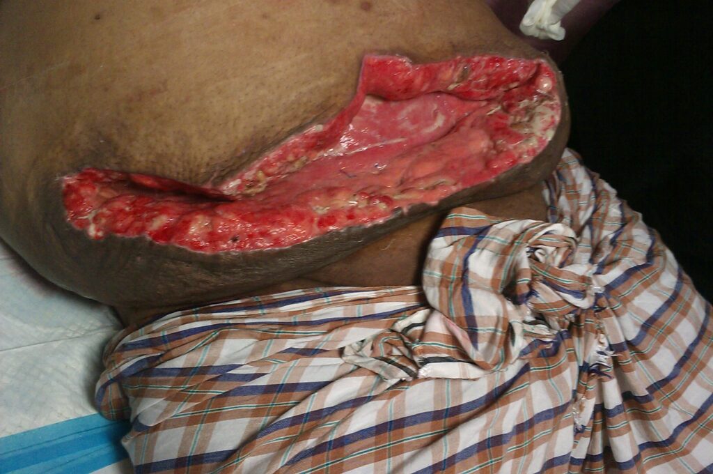 Clinical photograph showing separation of the superficial edges of a postoperative inguinal incision.
